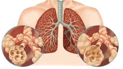 Всемирный день борьбы против хронической обструктивной болезни лёгких